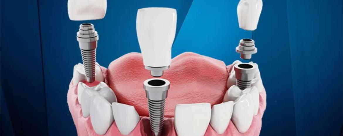 Implant Treatment Turkey in 2023: Technology Advancements, Pricing, and Procedure Details